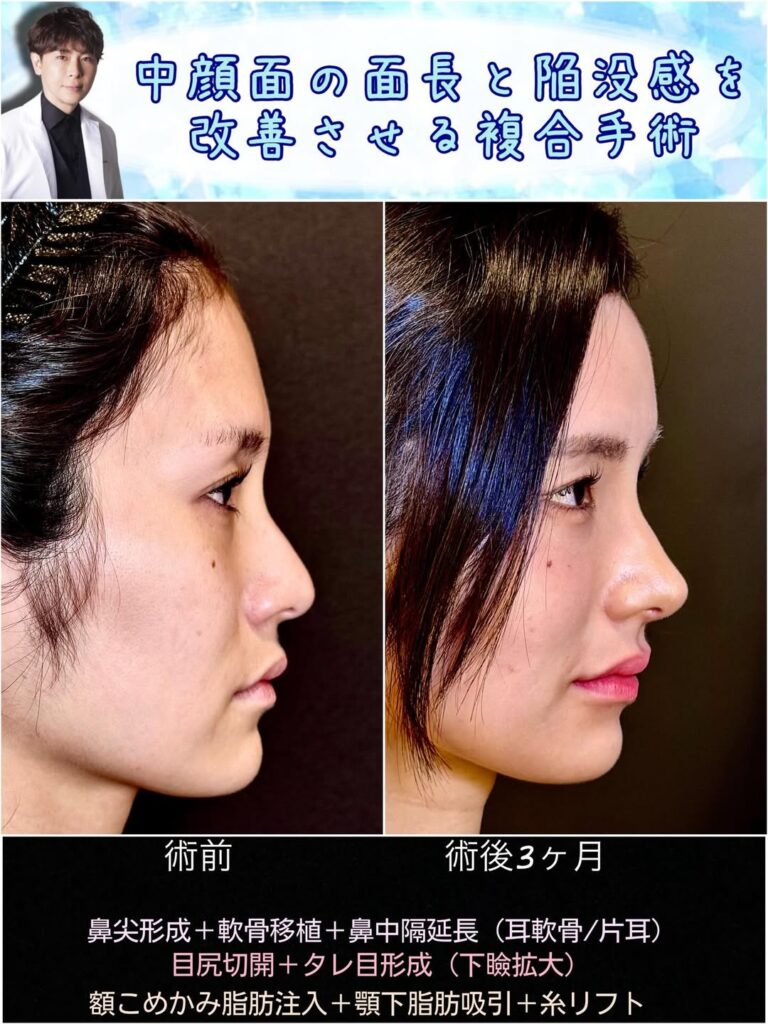 鼻尖形成と軟骨移植と鼻中隔延長と目尻切開とタレ目形成と脂肪注入と顎下の脂肪吸引とヒアルロン酸の症例写真 (2)