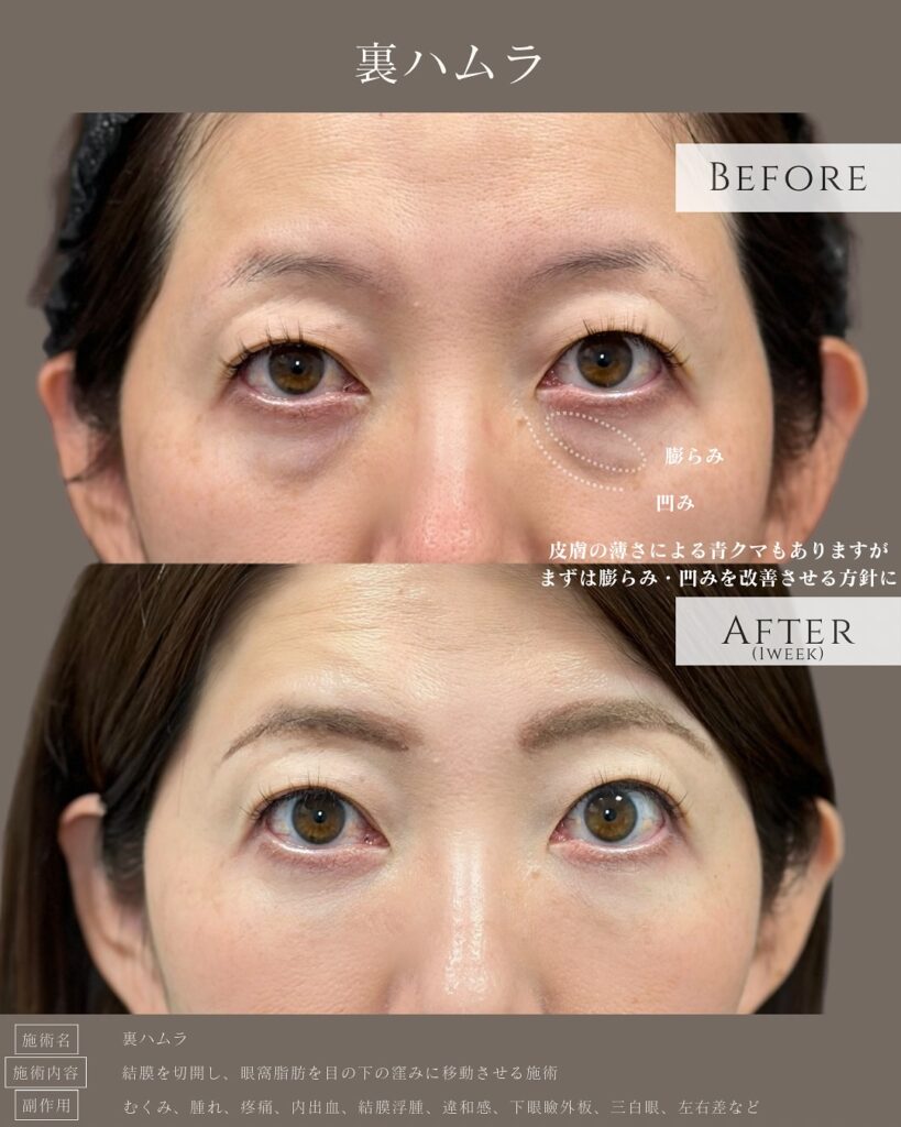 裏ハムラ法の症例写真 (33)