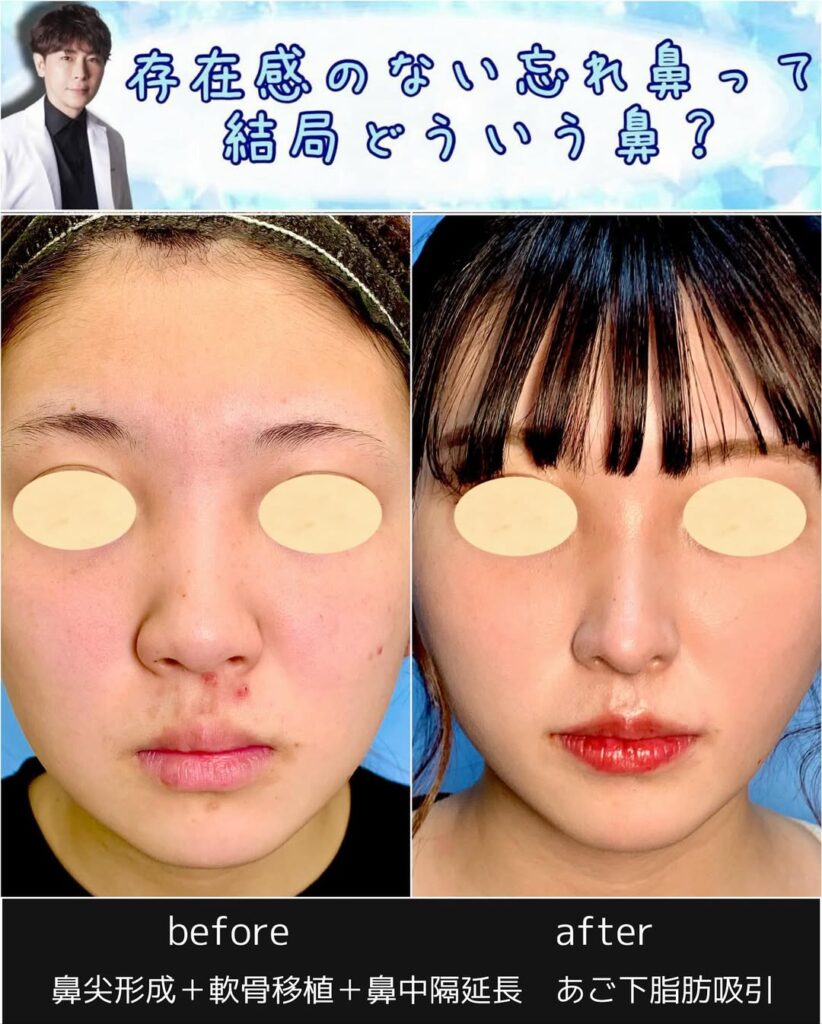 鼻尖形成と鼻中隔延長と軟骨移植と顎下の脂肪吸引の症例写真 (1)