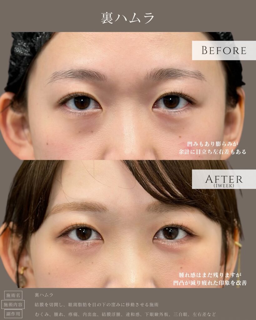 裏ハムラ法の症例写真 (36)