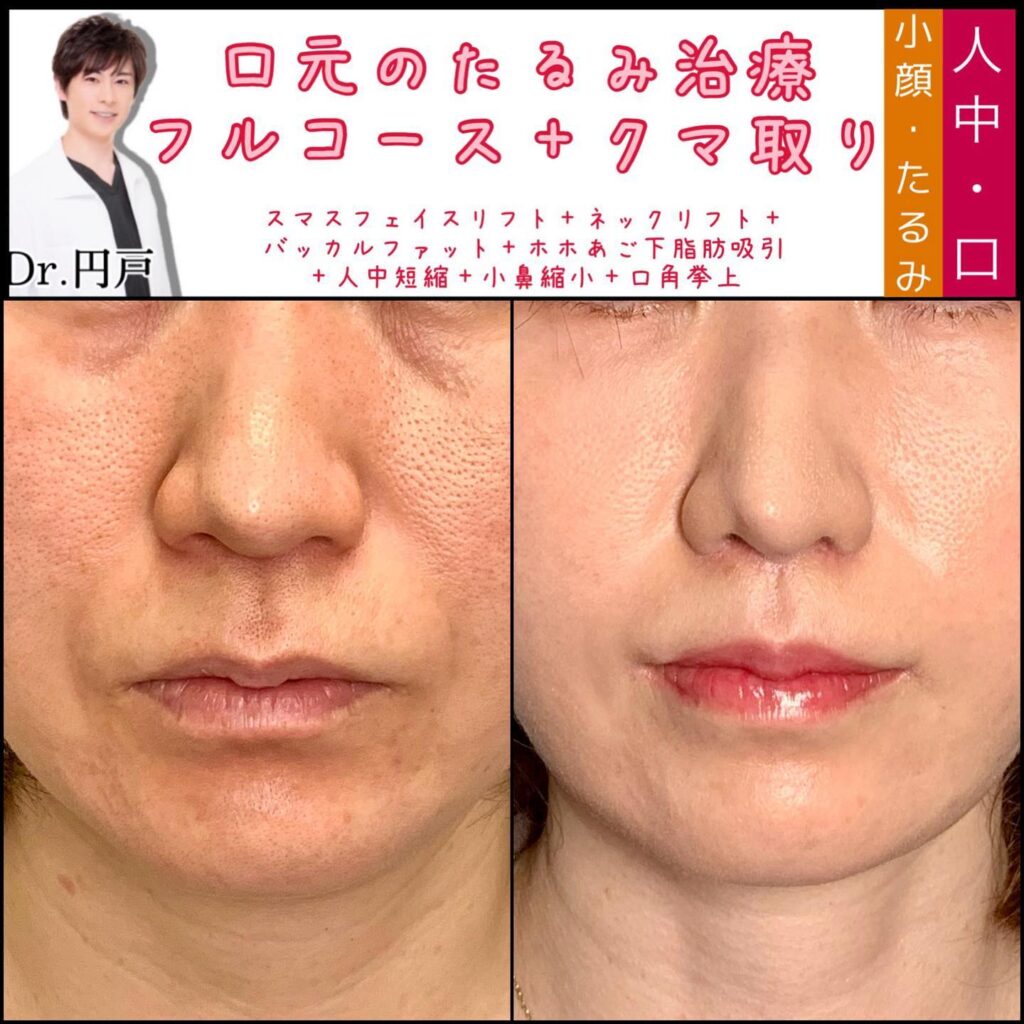 口角挙上と小鼻縮小と人中短縮の症例写真