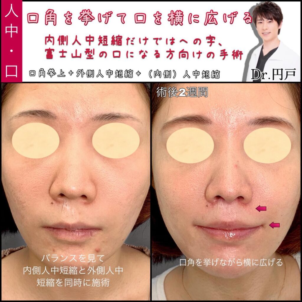 口角挙上と外側人中短縮と内側人中短縮を同時に行った2週間後の症例