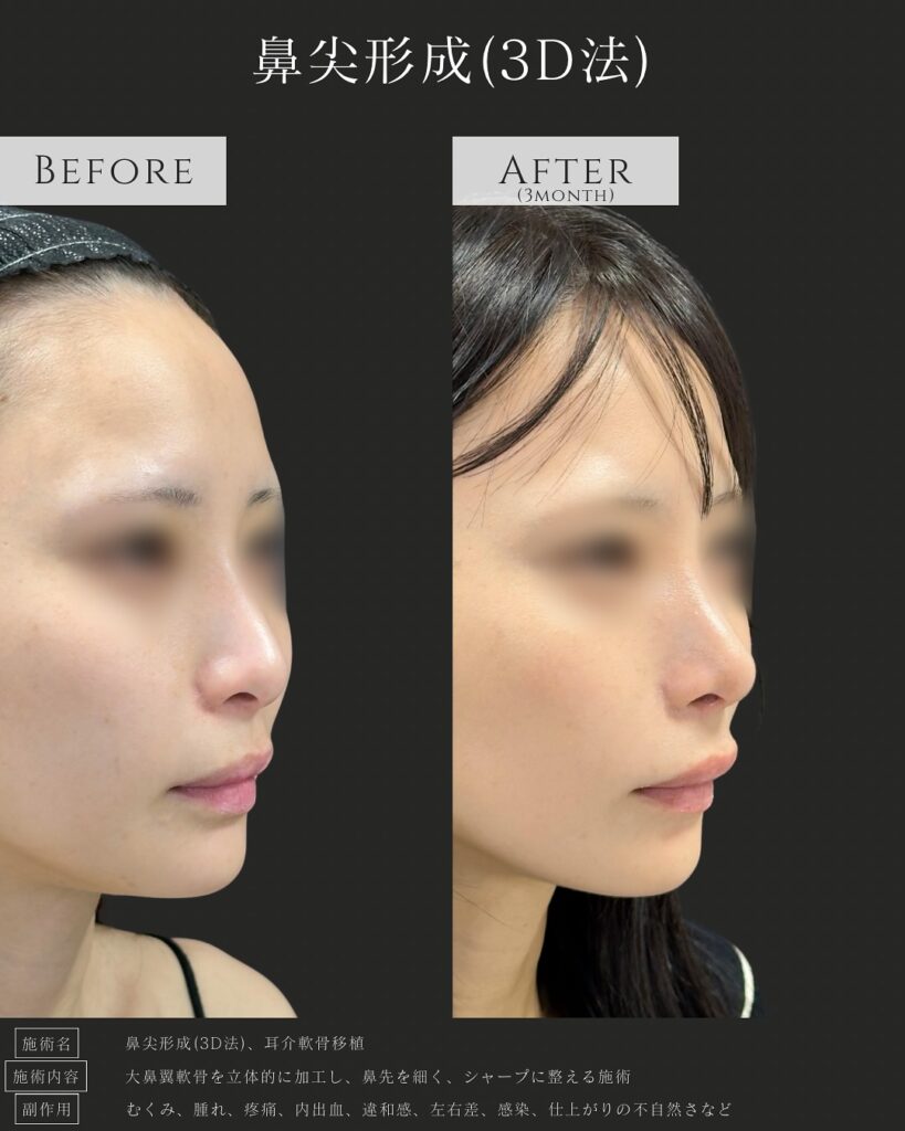 鼻尖形成と耳介軟骨移植の症例写真 (12)