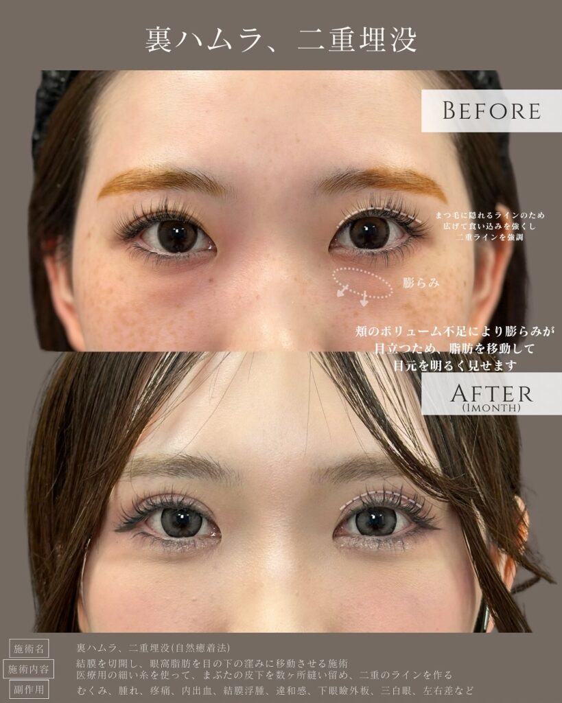 裏ハムラ法と自然癒着法の症例写真 (3)