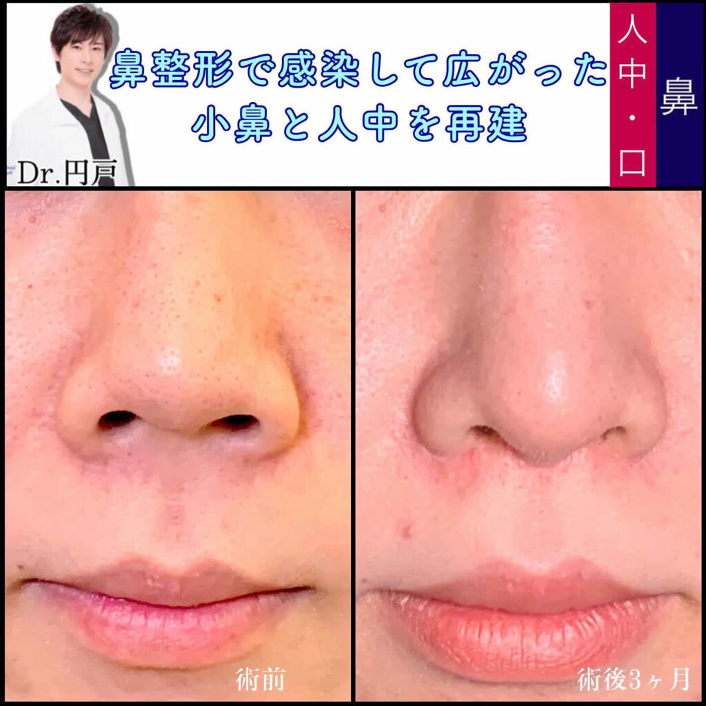 鼻整形で感染して広がった小鼻と人中を再建した修正手術の症例