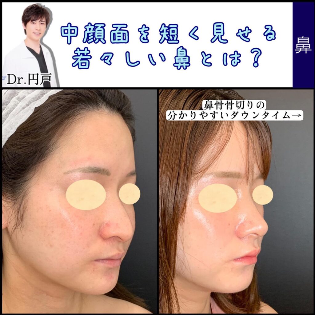 鼻骨骨切りと鼻尖形成の症例写真 (2)