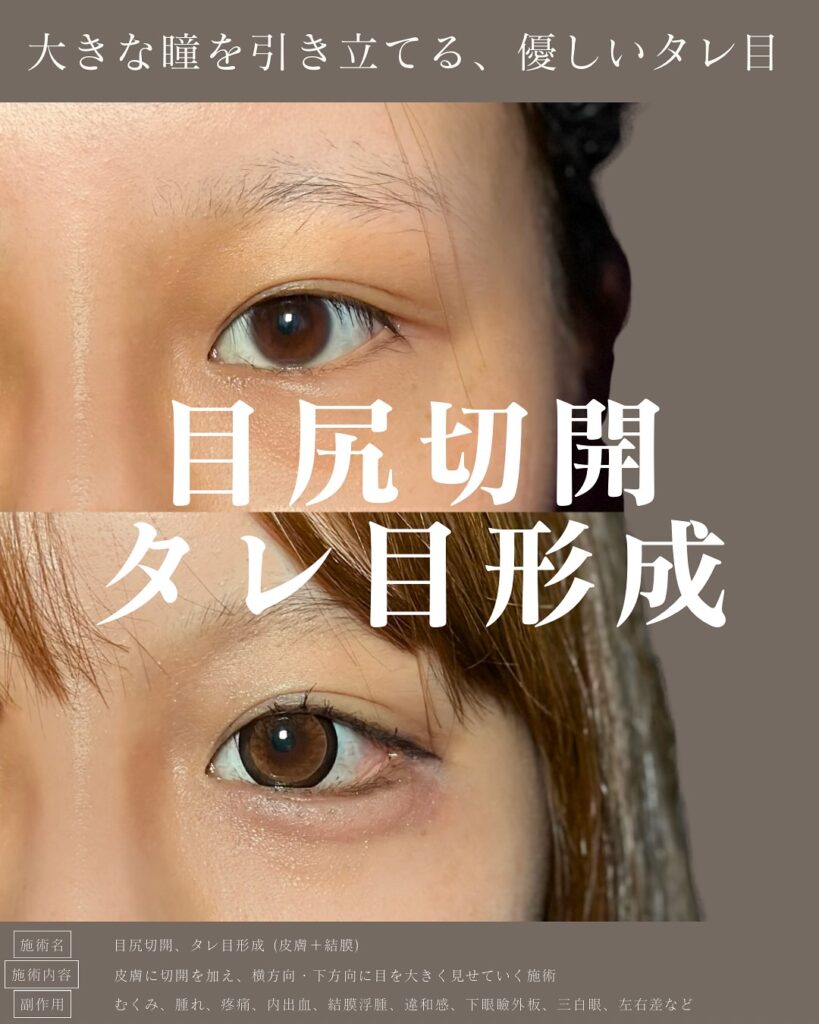 目尻切開とタレ目形成の症例写真 (6)