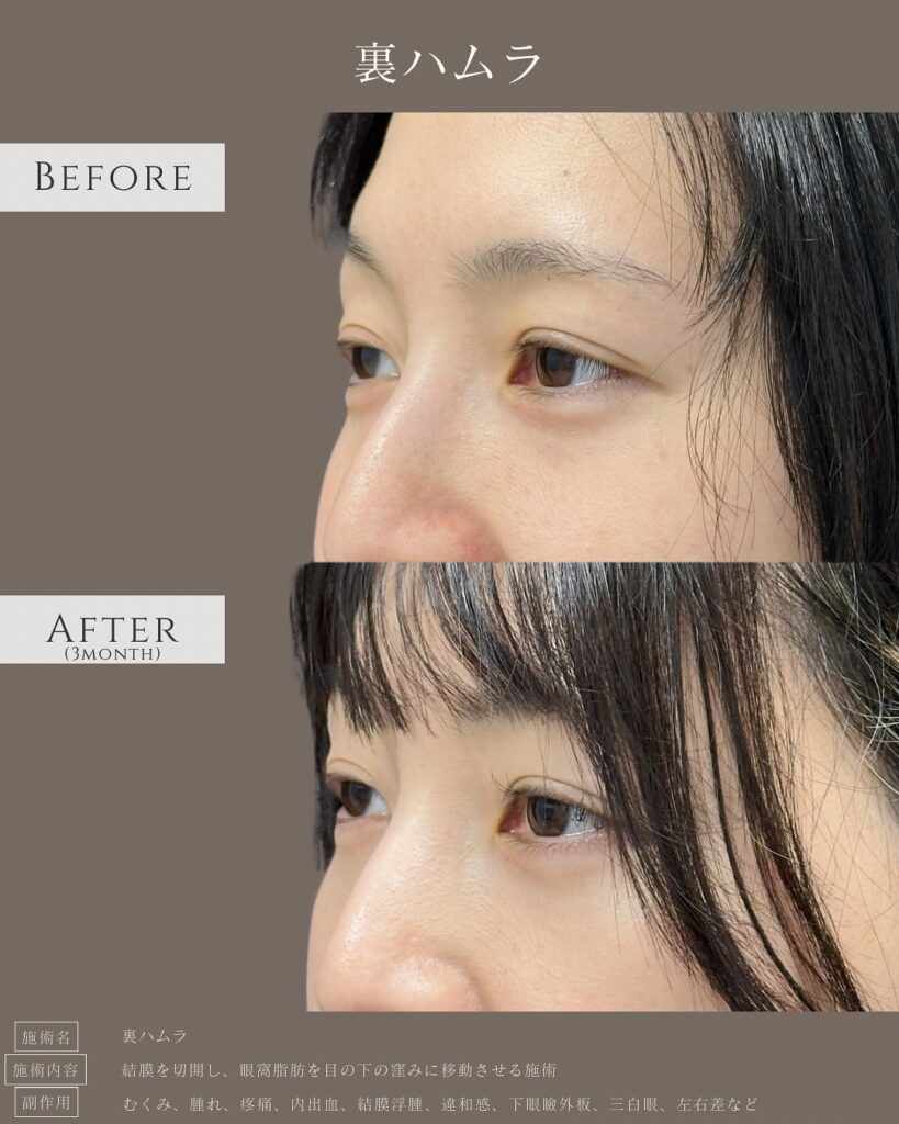 裏ハムラ法の症例写真 (41)