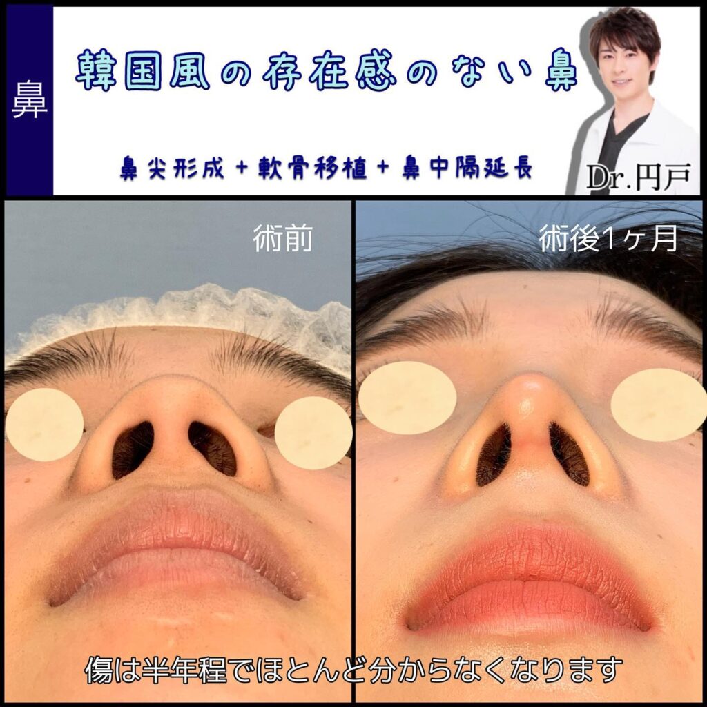 鼻中隔延長、軟骨移植、鼻尖形成の1ヶ月後の症