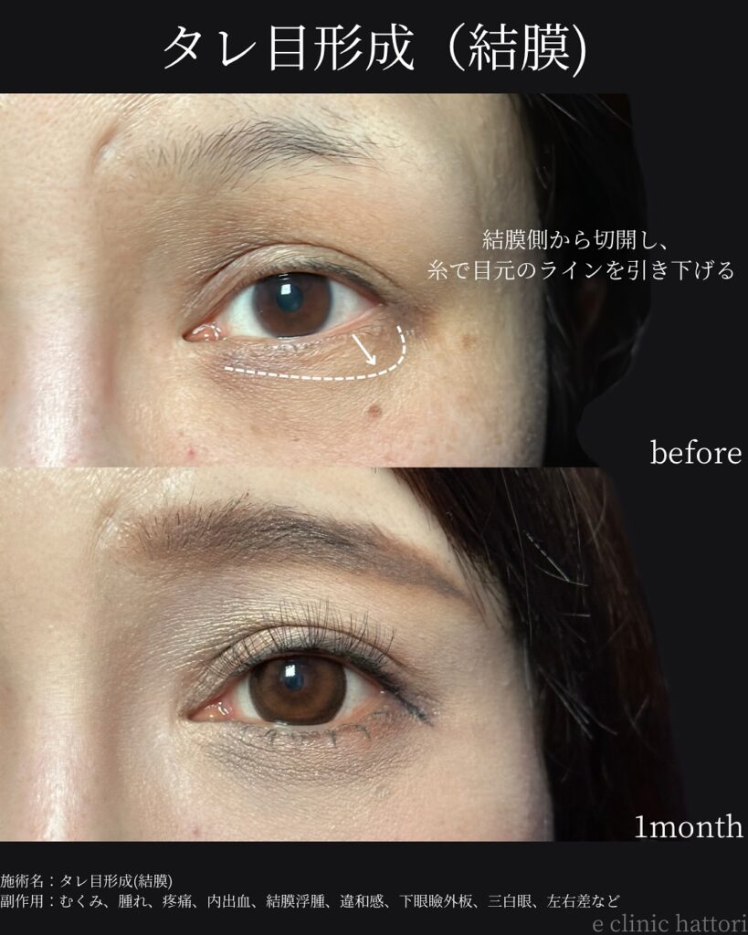 タレ目形成の症例写真 (27)