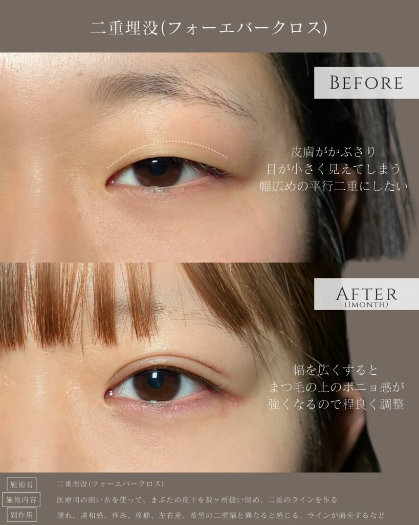 埋没法の症例写真 (11)