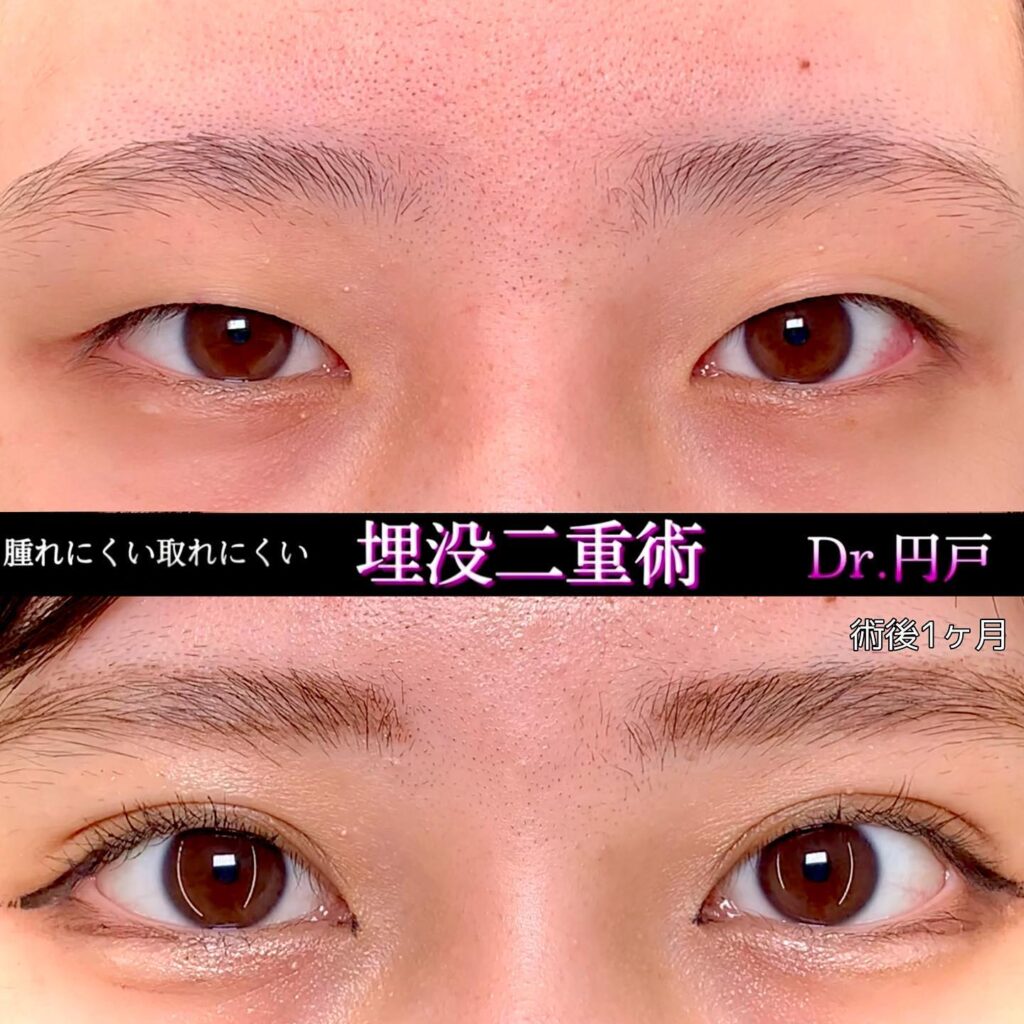 埋没法の症例写真 (11)