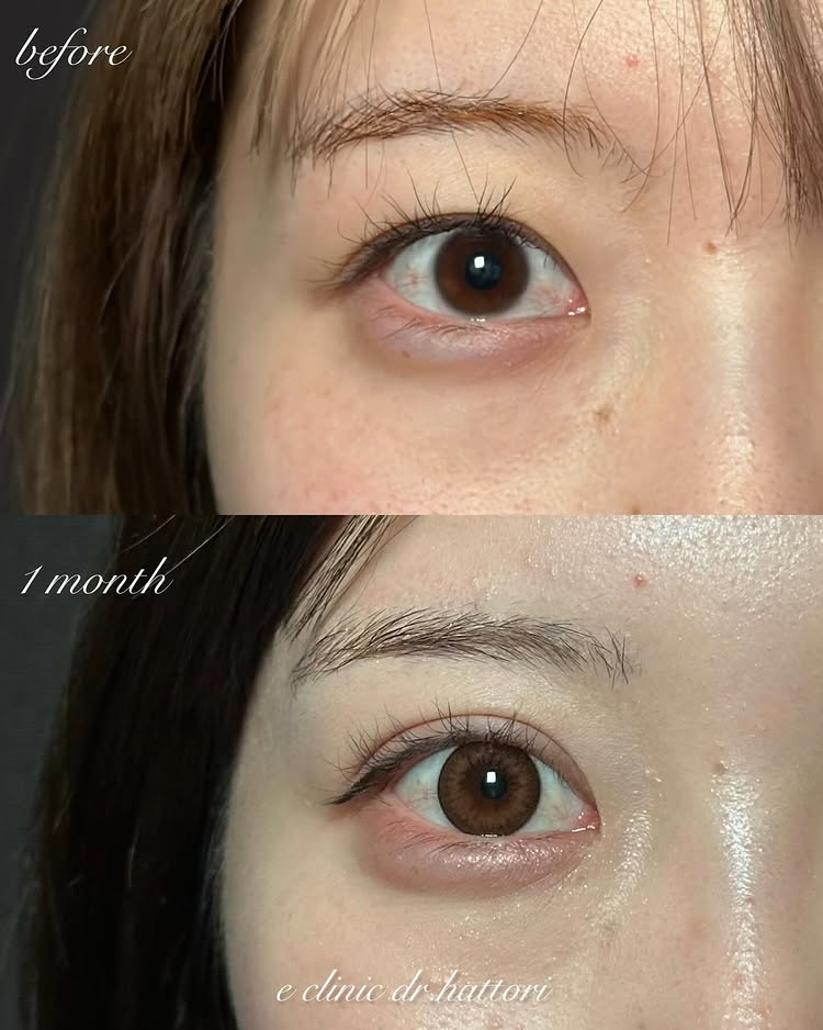 埋没法と涙袋のヒアルロン酸の症例写真 (1)