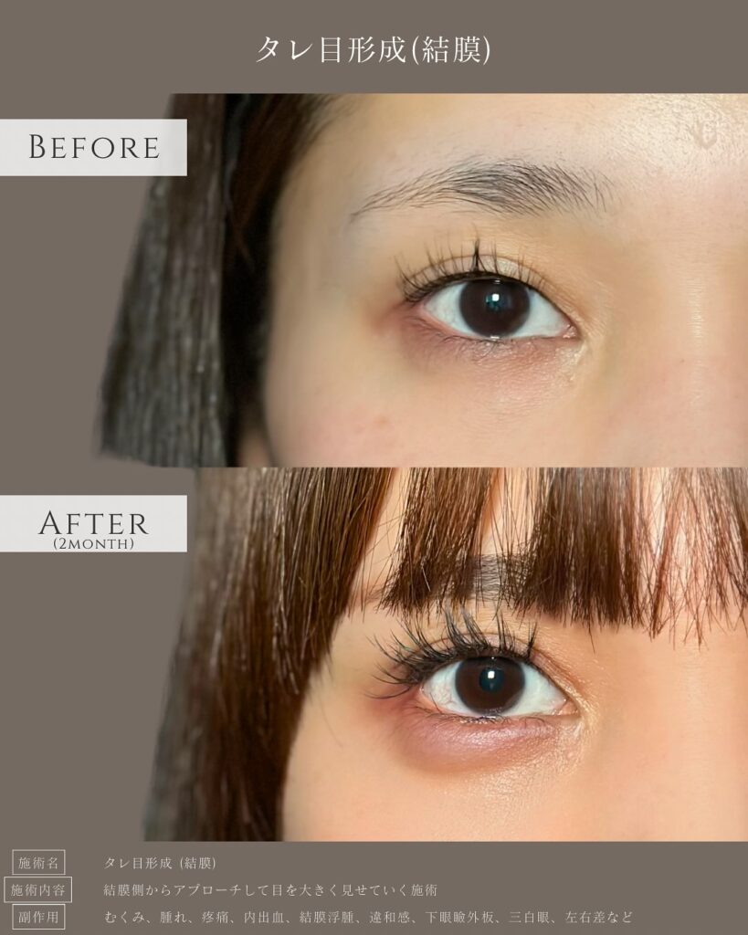 タレ目形成の症例写真 (18)