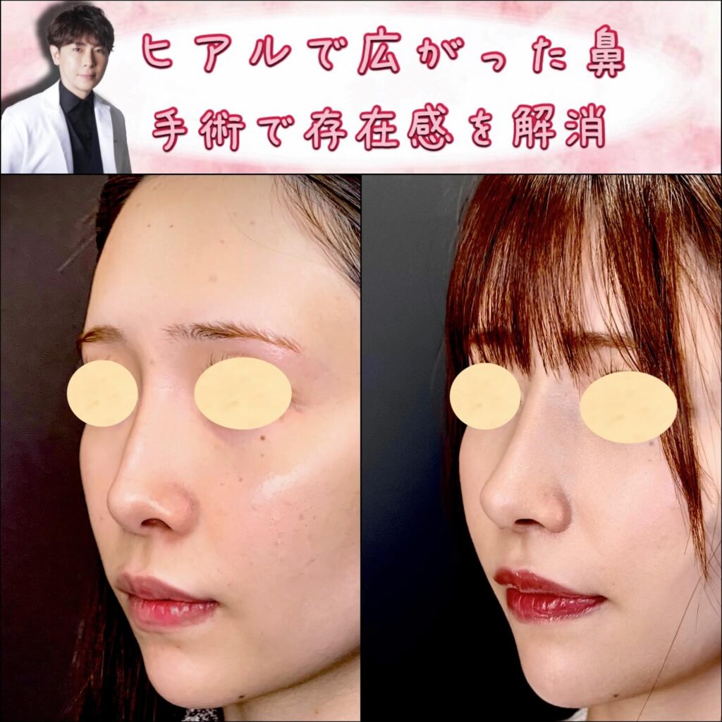 鼻尖形成と軟骨移植と鼻中隔延長とプロテーゼと小鼻縮小とヒアルロン酸溶解注射の症例写真 (1)