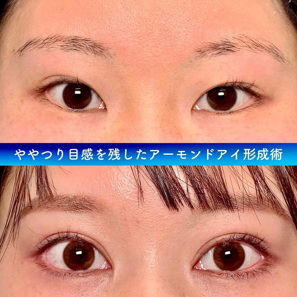 タレ目形成の症例写真