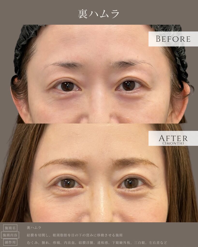 裏ハムラ法の症例写真 (8)