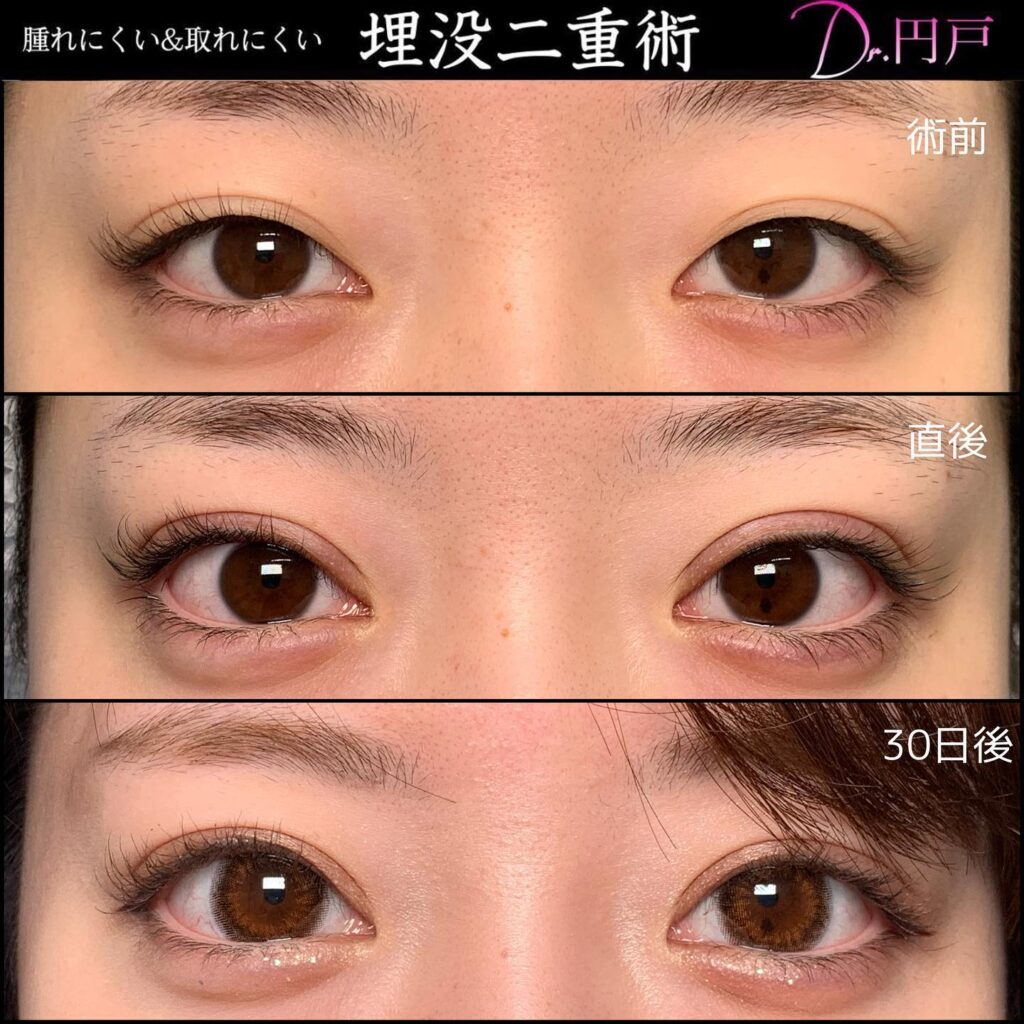 埋没法の症例写真 (21)