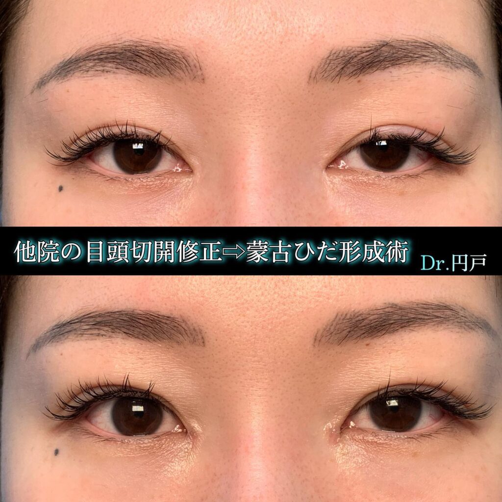 目頭切開の他院修正 (2)