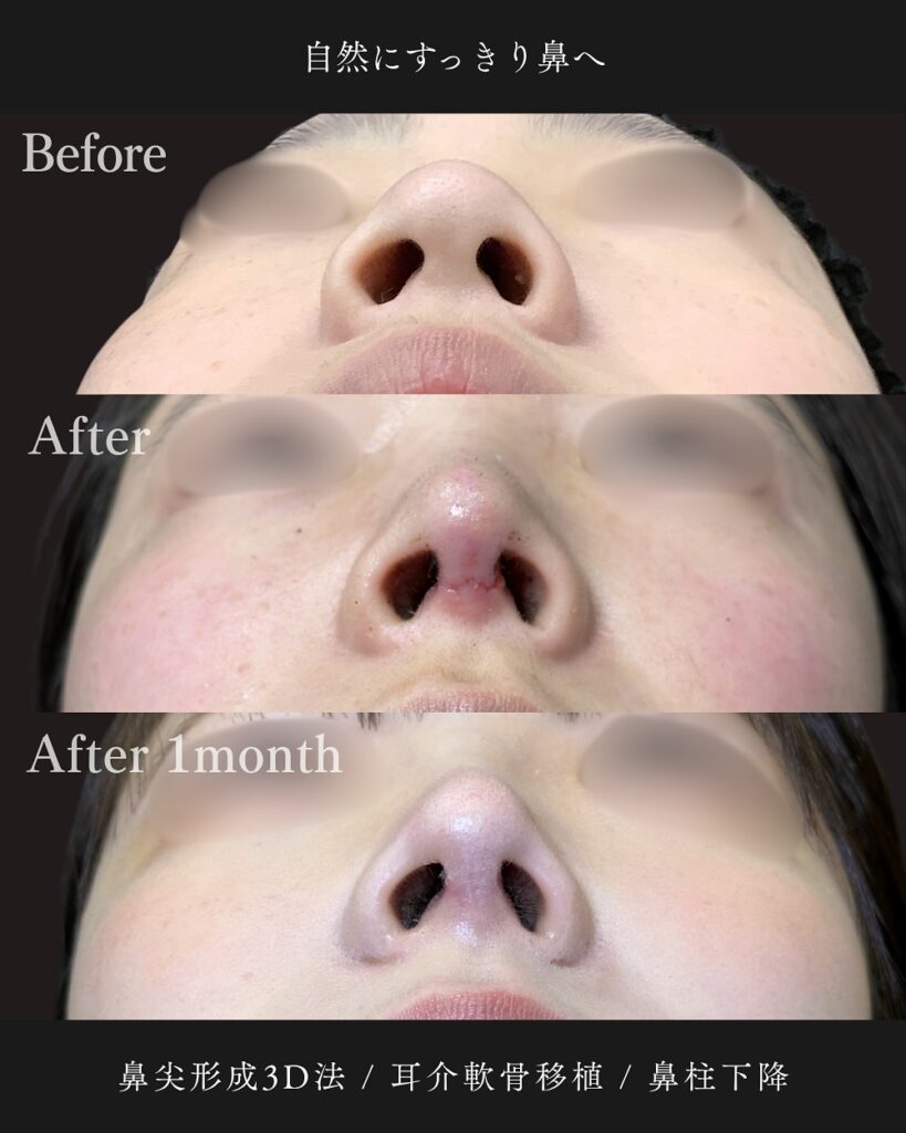 鼻尖形成3D法と耳介軟骨移植と鼻柱下降の症例写真 (4)