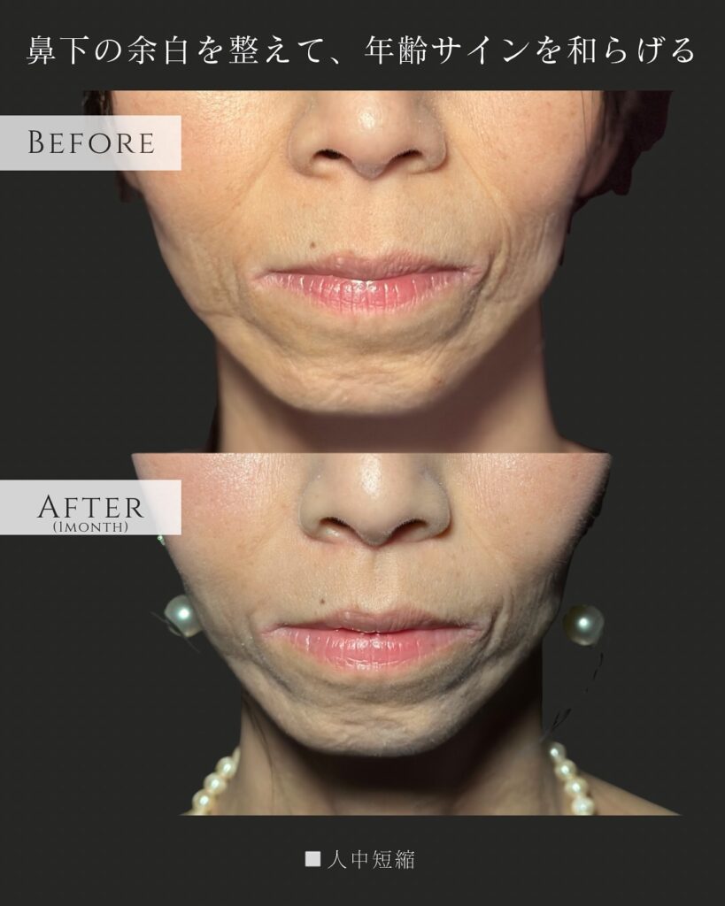 人中短縮の症例写真 (2)