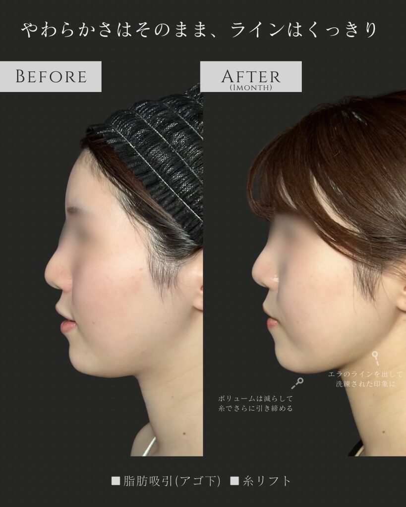 顎下の脂肪吸引と糸リフトの症例写真 (8)