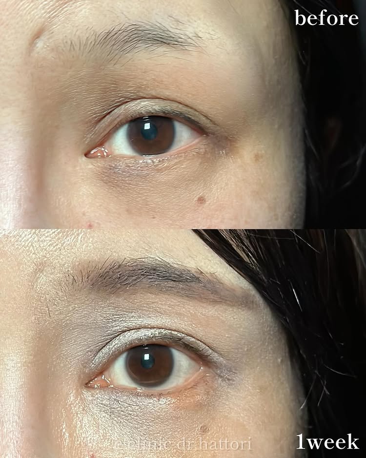 タレ目形成の症例写真 (32)