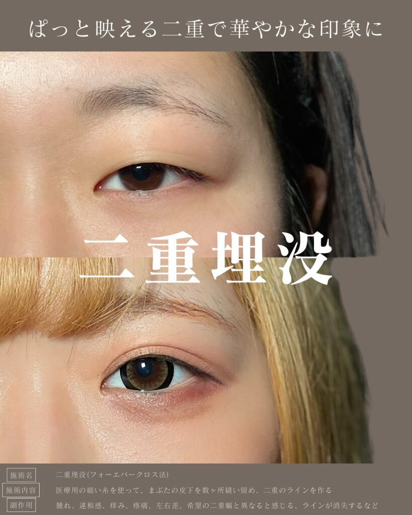 埋没法の症例写真 (4)