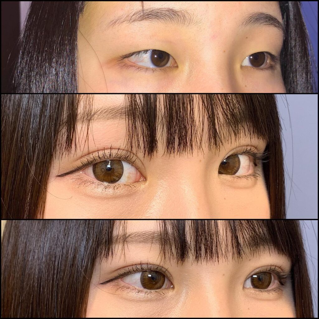 埋没法の症例写真 (4)