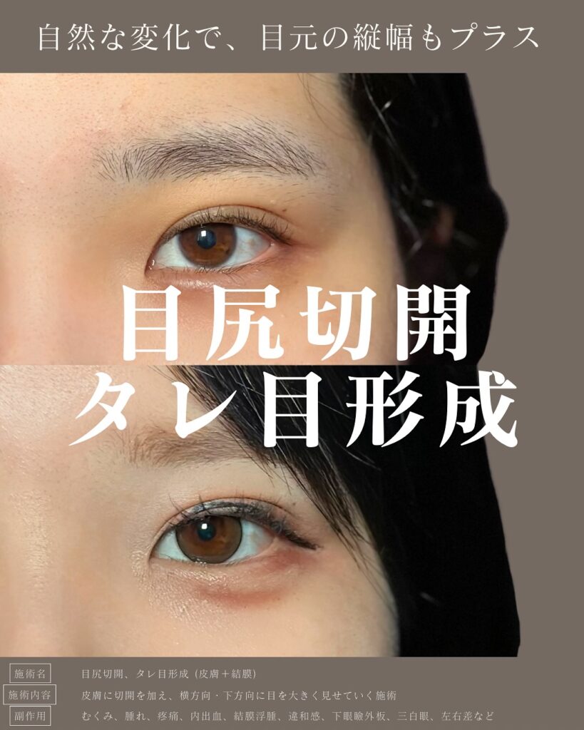 目尻切開とタレ目形成の症例写真 (11)