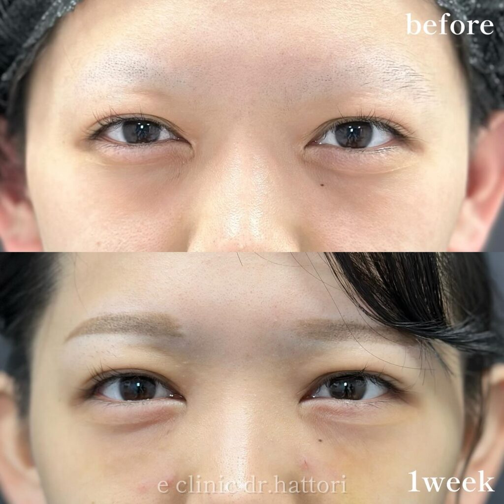 裏ハムラ法の症例写真 (75)