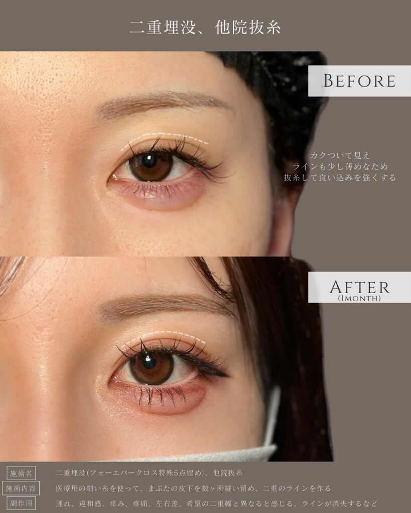 埋没法と他院抜糸の症例写真 (5)