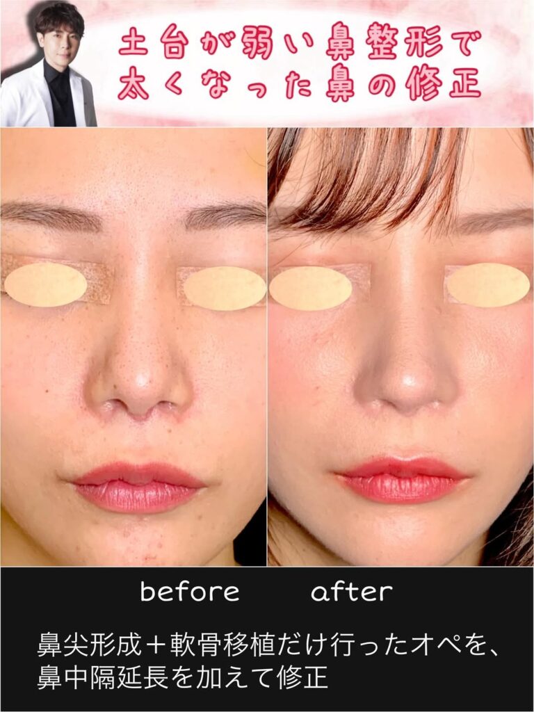 鼻尖形成と軟骨移植と鼻中隔延長の症例写真 (1)