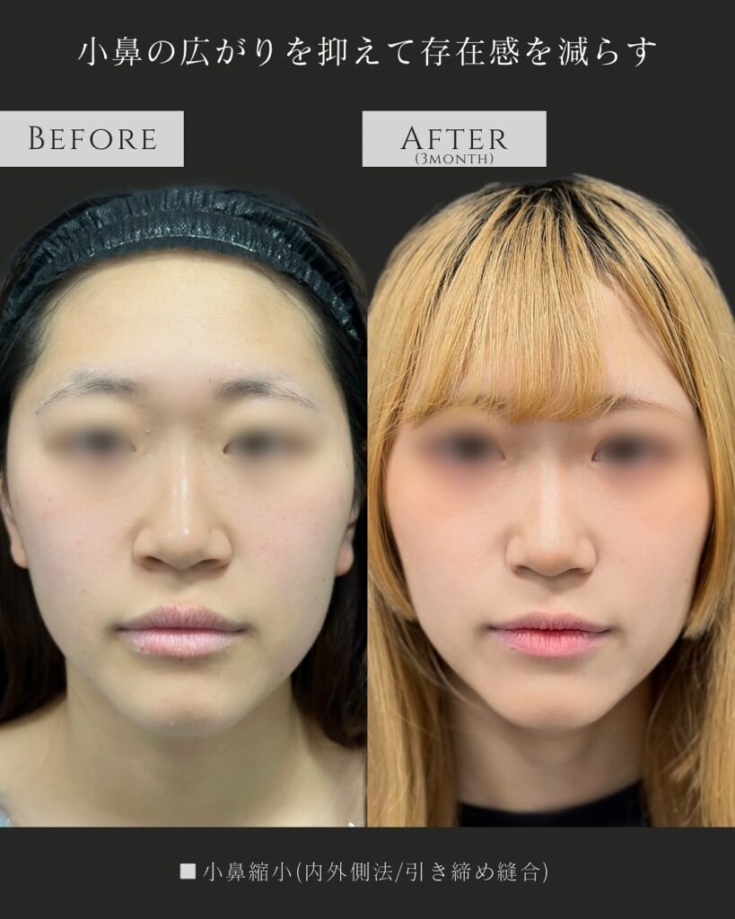 小鼻縮小の症例写真 (5)