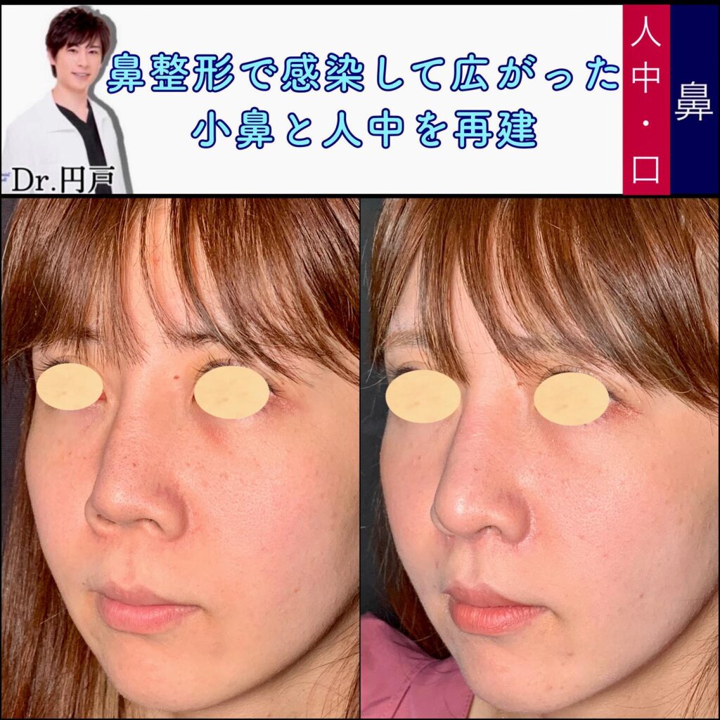 鼻と口の他院修正の症例写真 (2)