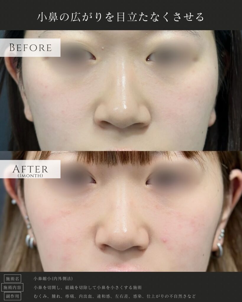 小鼻縮小の症例写真 (7)