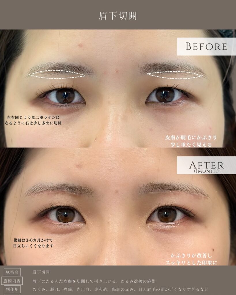眉下切開の症例写真 (4)
