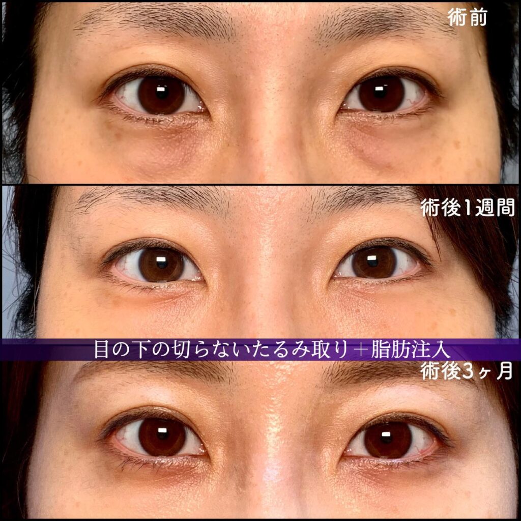 目の下の切らないたるみ取りと脂肪注入の症例写真 (3)