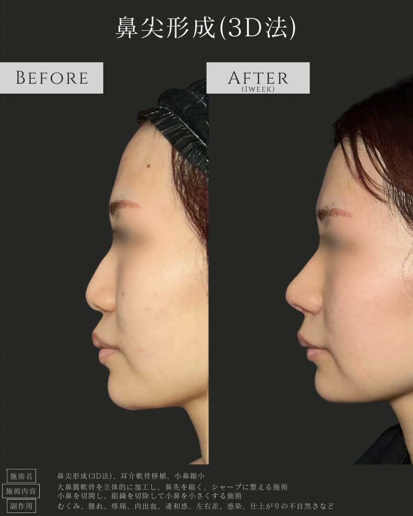 鼻尖形成と耳介軟骨移植と小鼻縮小の症例写真 (4)