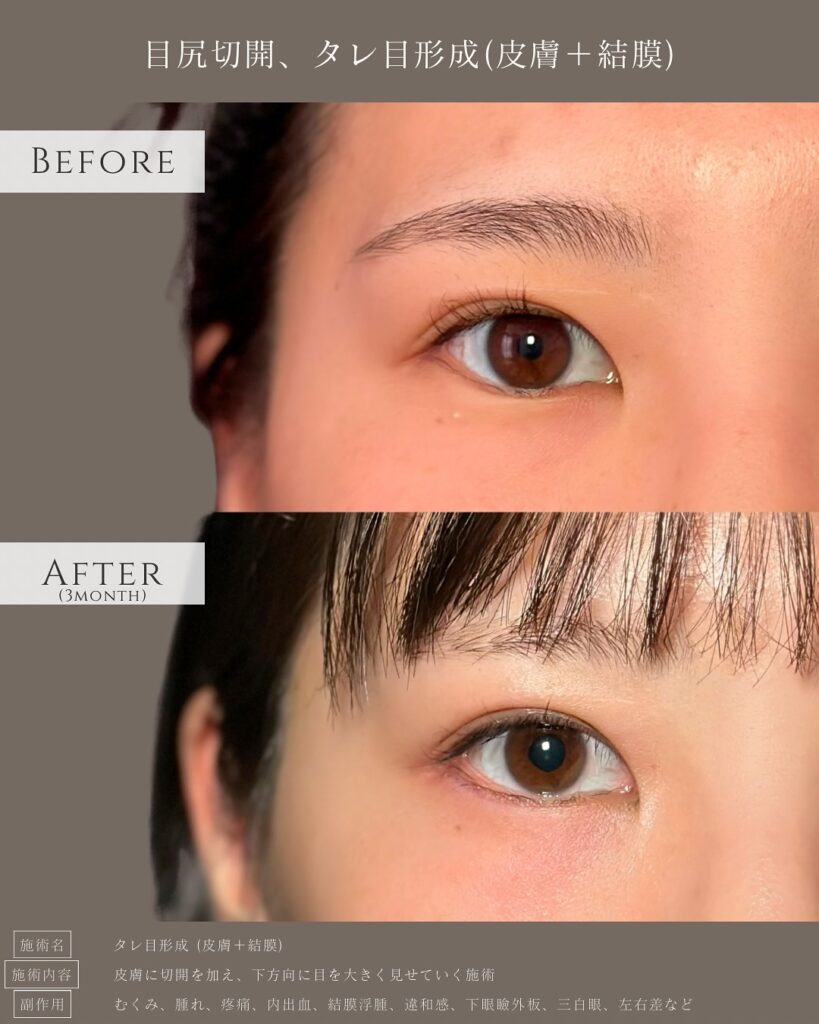 タレ目形成の症例写真 (14)