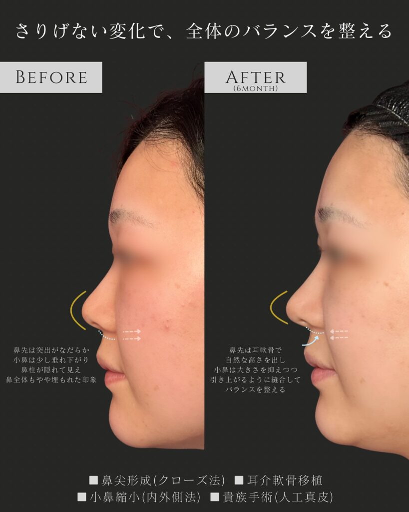 鼻尖形成と耳介軟骨移植と小鼻縮小と貴族手術の症例写真 (4)
