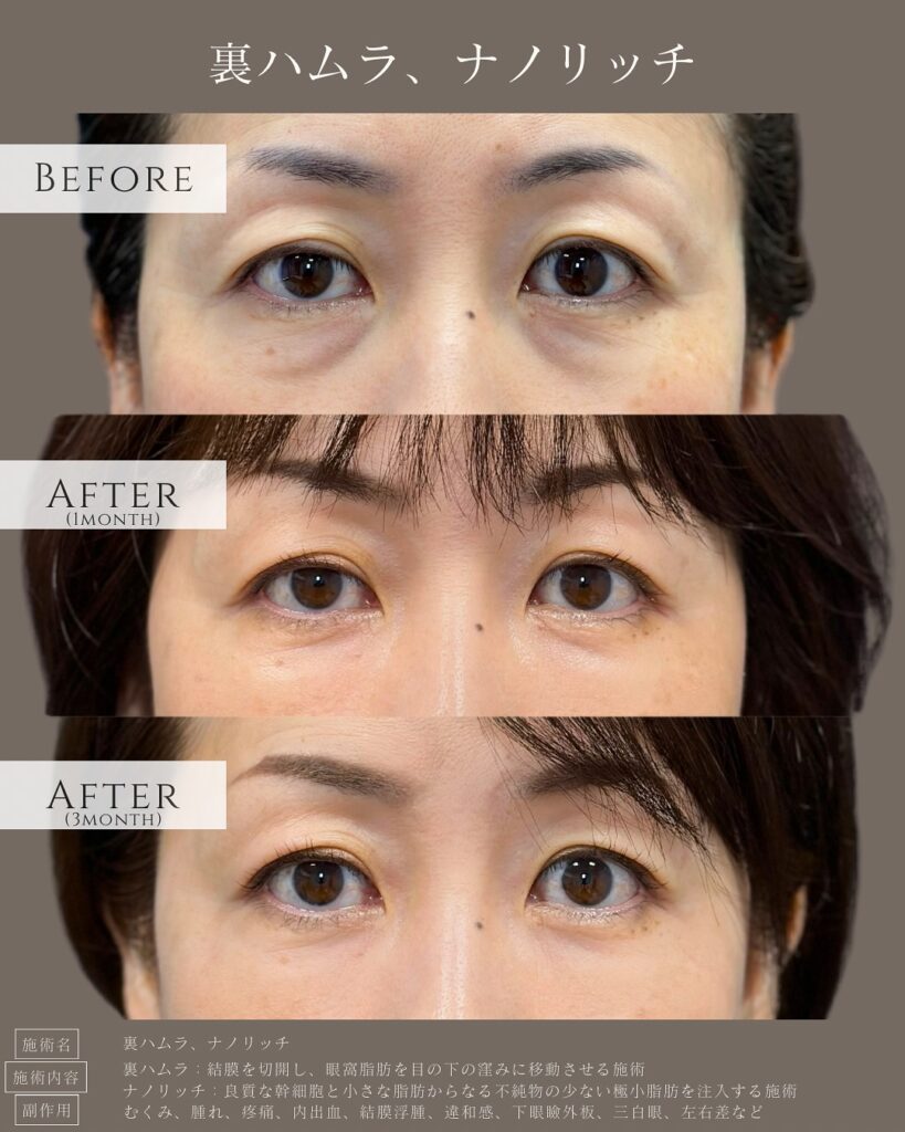 裏ハムラ法とナノリッチの症例写真 (2)