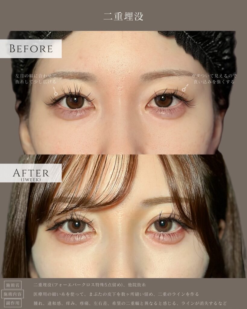 埋没法と他院の抜糸の症例写真 (3)