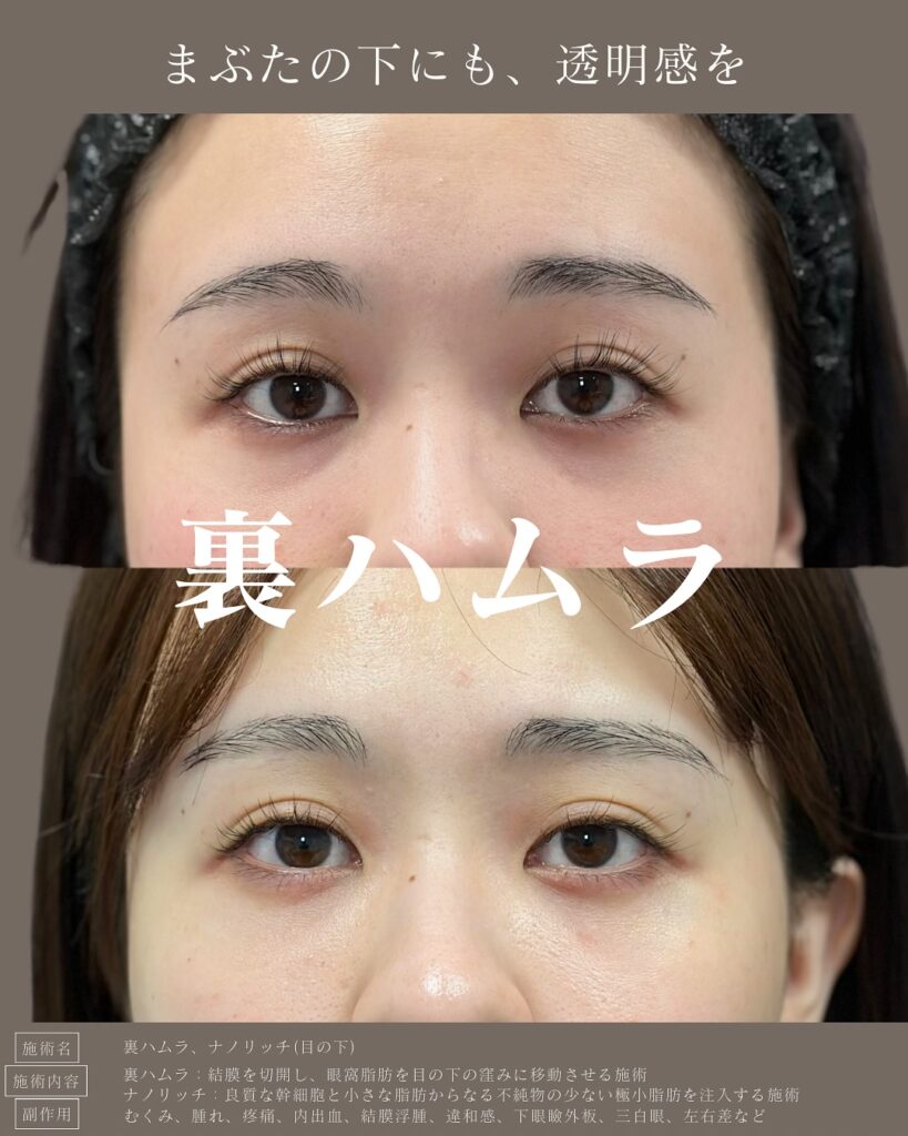 裏ハムラ法とナノリッチ症例写真 (3)