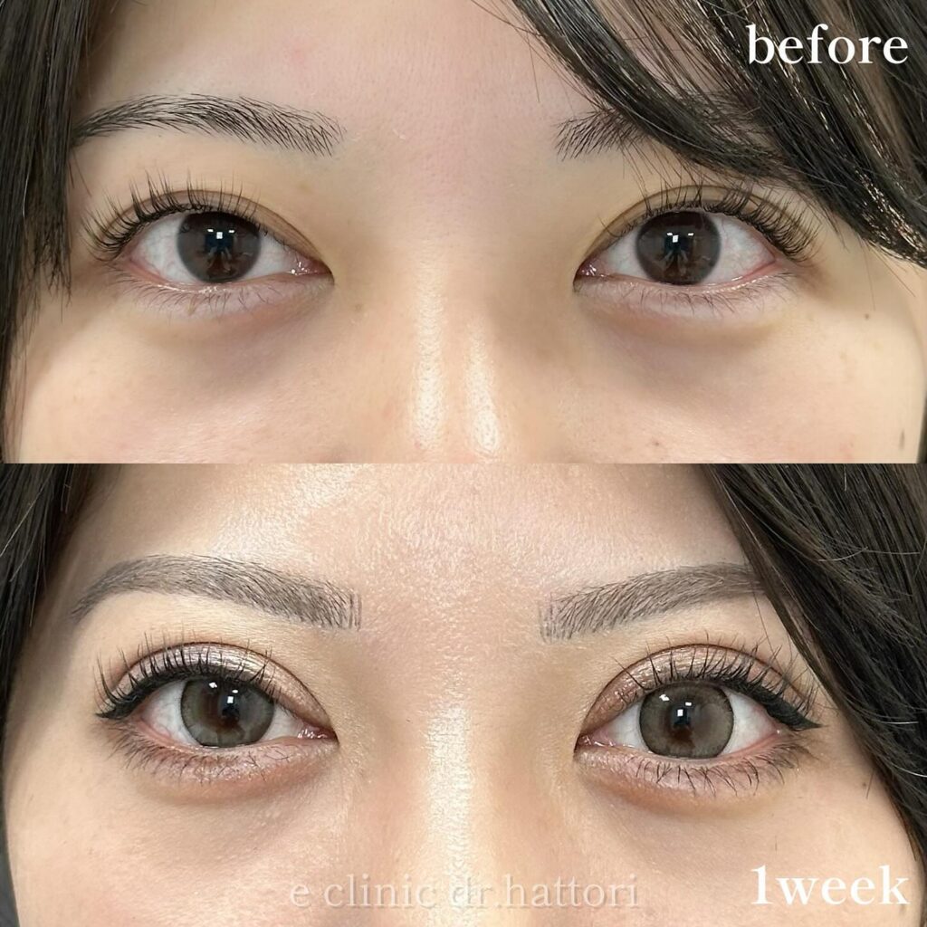 自然癒着法の症例写真 (19)