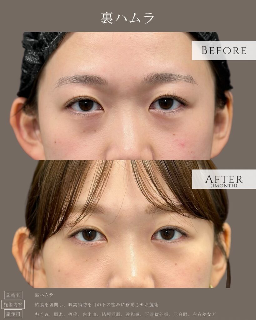 裏ハムラ法の症例写真 (26)