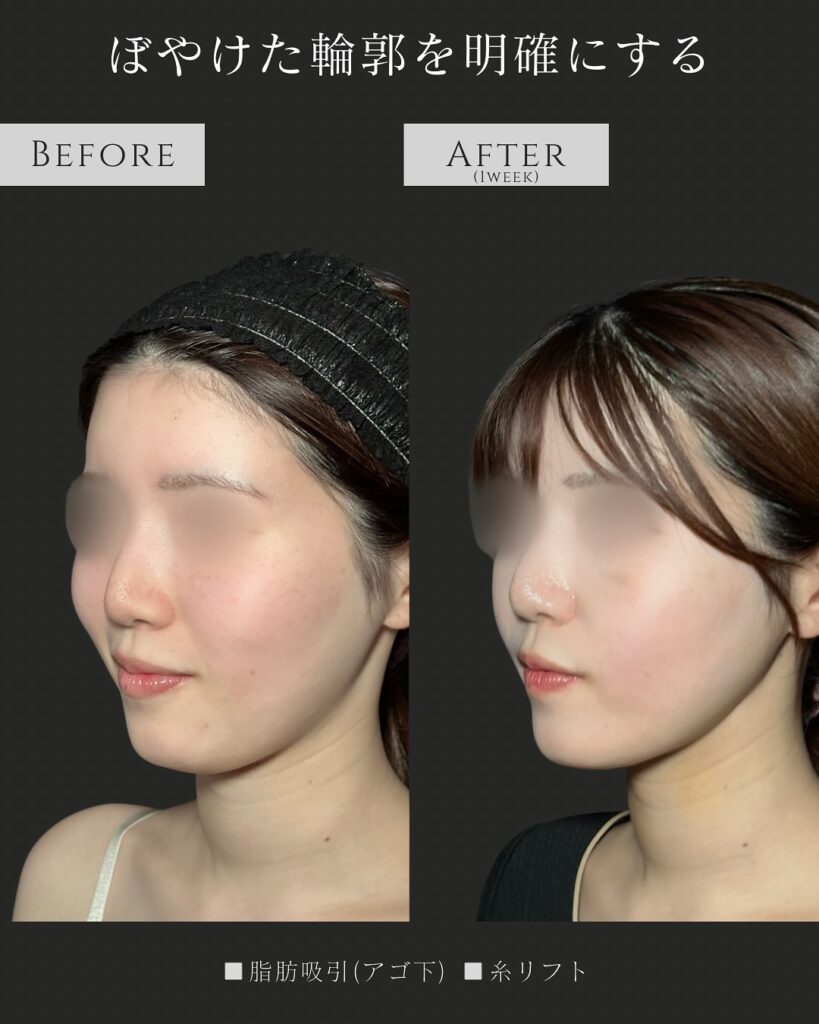 顎下の脂肪吸引と糸リフトの症例写真 (11)