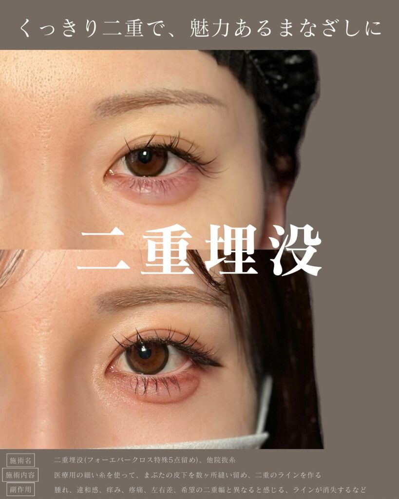 埋没法と他院抜糸の症例写真 (1)