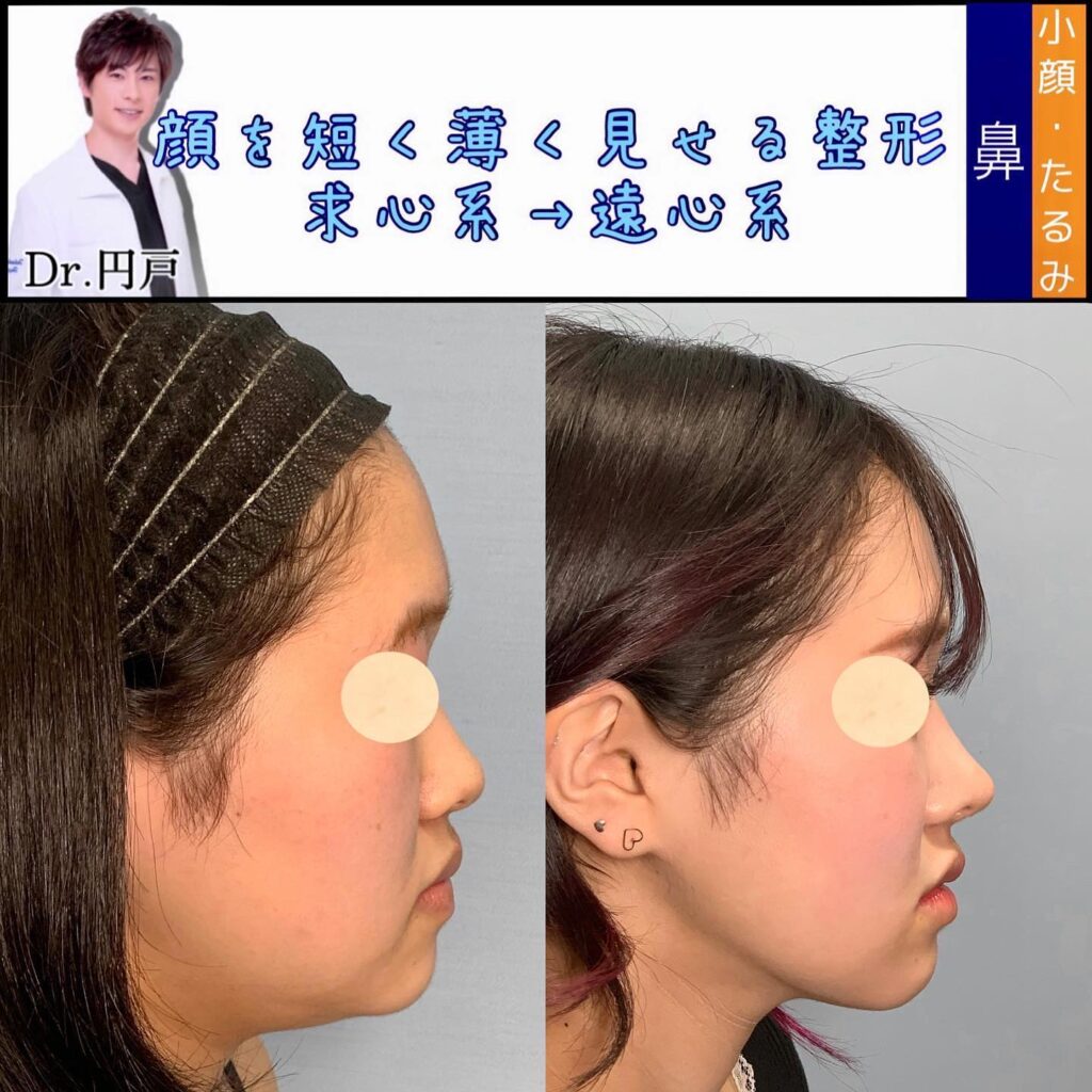 プロテーゼと鼻尖形成と軟骨移植と鼻中隔延長の症例写真 (2)