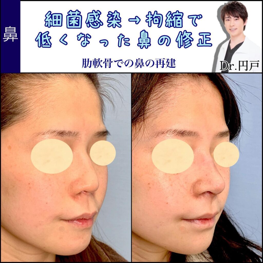 細菌が感染し拘縮してしまい鼻が低くなってしまって肋軟骨で修正した他院修正の鼻の症例